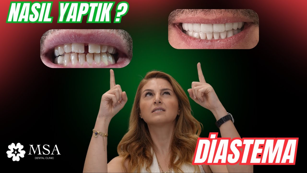 Bu Gülüş Gerçek Olamaz?... Lamine Kaplamalarla Müthiş Dönüşüm