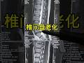 看看退化後的椎間盤 #健康 #科普 #医学科普 #椎間盤突出 #腰痛 #坐骨神經痛