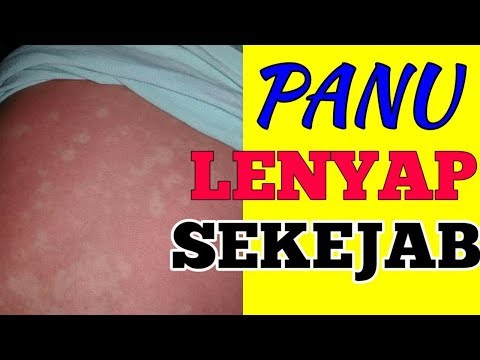 panu-hilang-dalam-sekejab-|-cara-menghilangkan-panu-dengan-cepat-&-alami