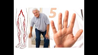5 типичных признаков поражения артерий ног: простыми словами. Атеросклероз нижних конечностей ОАСНК.