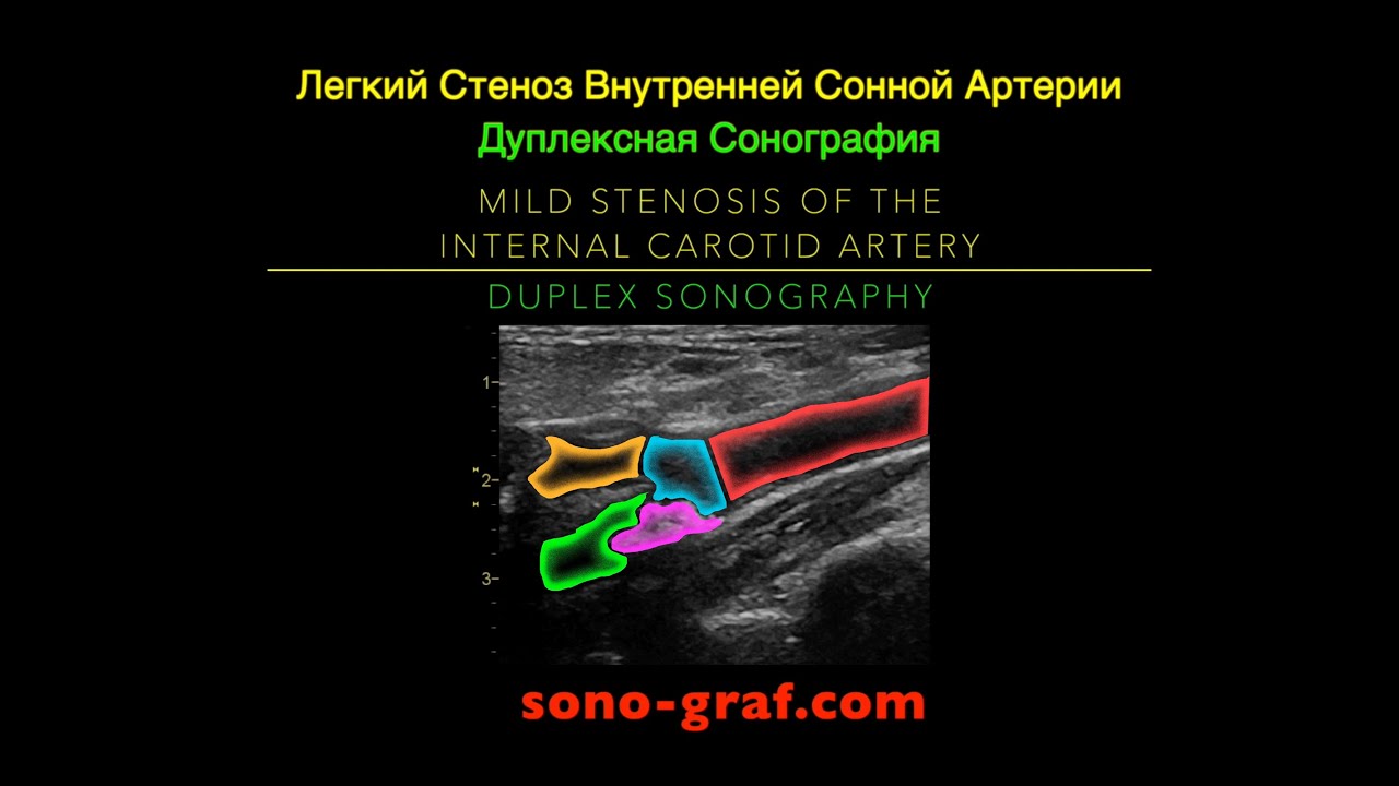 Дуплексная Сонография - Легкий Стеноз Внутренней Сонной Артерии - YouTube