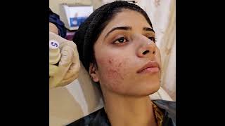 HOW TO GET RID OF ACNE ON CHEEKS.Chemical Peel  ACNE AND DARK SPOT TREATMENT .DR SHEHNAZ, PART 2