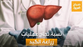 صباح العربية | زراعة الكبد.. نسب النجاة بعد العملية