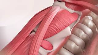 APrevent® VOIS_Standardized type I thyroplasty