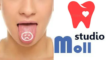 Come levare la patina bianca sulla lingua?