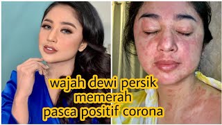 Dewi persik positif corona | covid 19