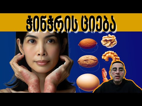 ჭინჭრის ციება - ნიშნები, სიმპტომები და მკურნალობა (ურტიკარია)