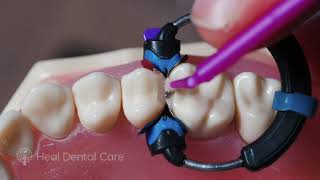 How to make adjacent Class II restorations with consistency Dentist demonstration