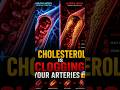 How Cholesterol Damages Your Arteries | What Is Dyslipidemia?