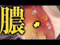 神経が無い歯に膿の通り道ができました　速やかに膿をきれいにします　歯医者かおりです