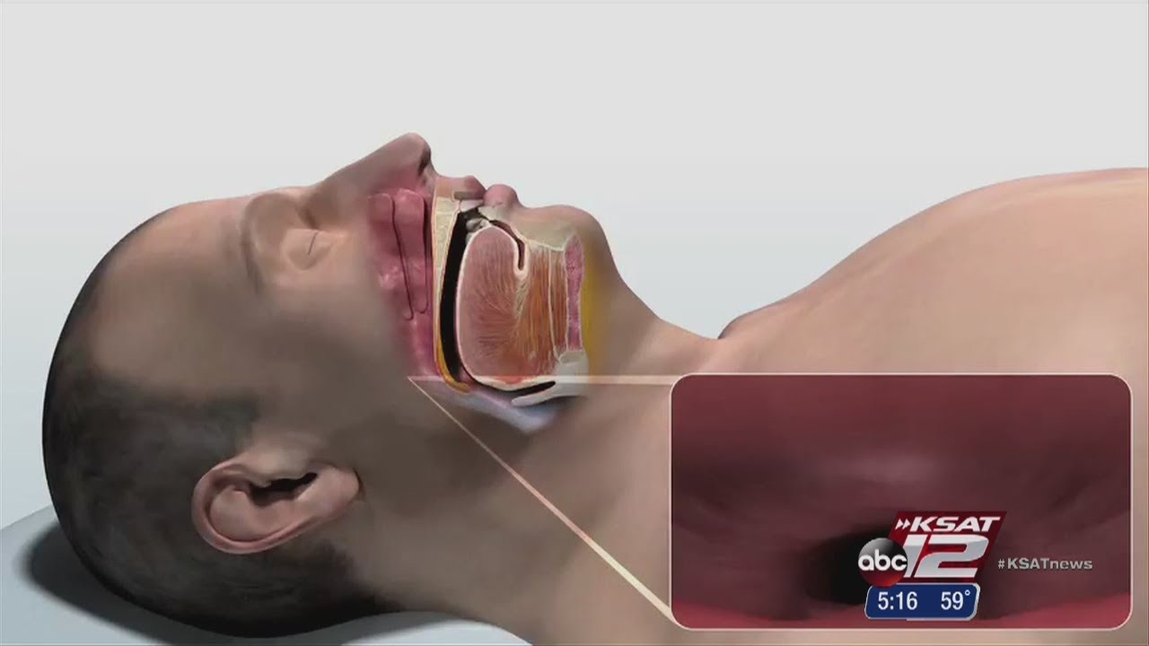 New sleep apnea surgery performed in San Antonio YouTube