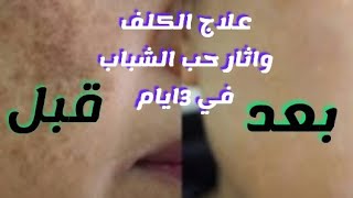 علاج الكلف والبقع الداكنة واثار حب الشباب في 3ايام /وجه ابيض فورا/بشرة صافية مثل بشرة الاطفال