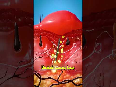 كيف يتم إزالة شظية من الجلد 
