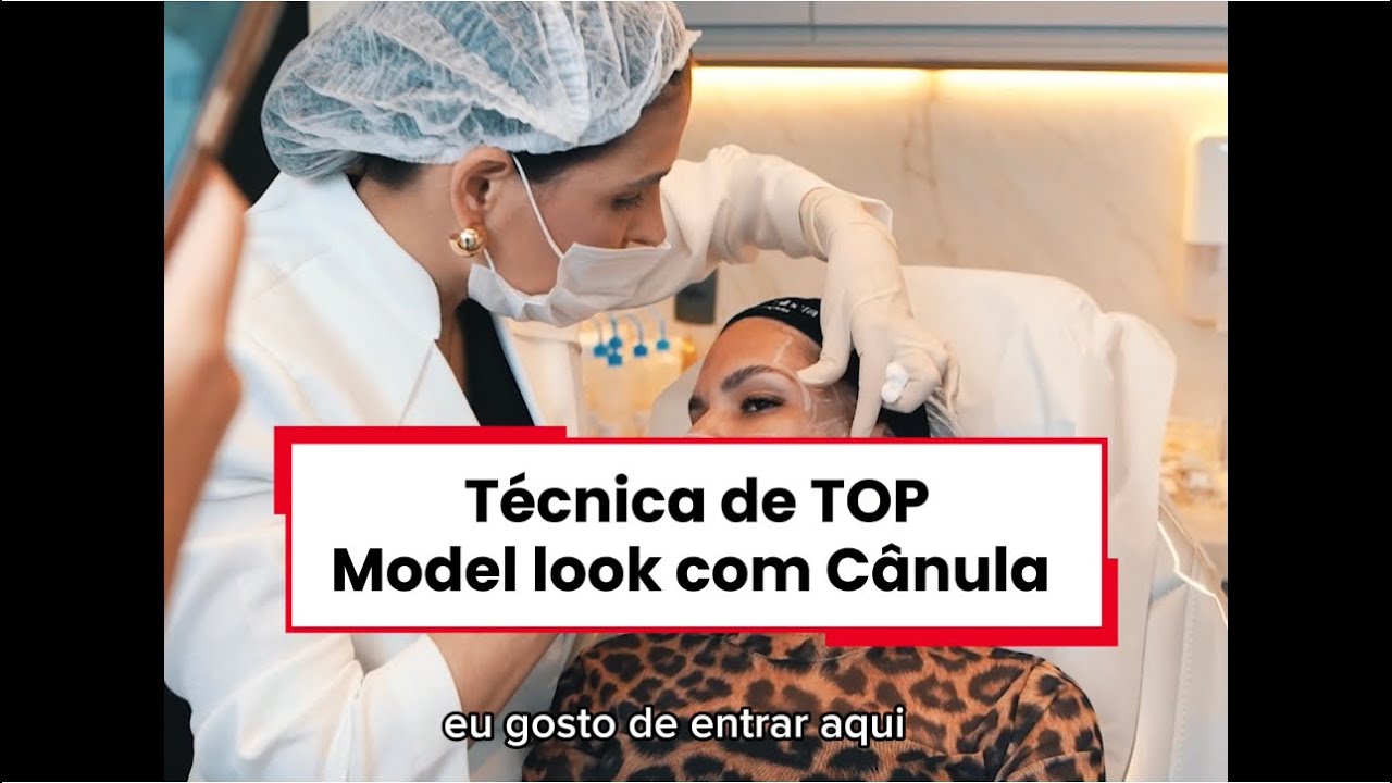 Técnica de preenchimento de zigoma (TOP MODEL LOOK) com cânula.