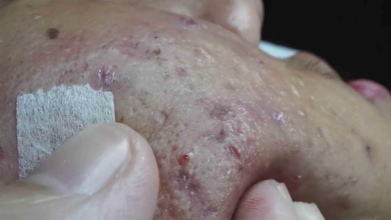 Popping Blackheads and Pimples for Day 14 YouTube