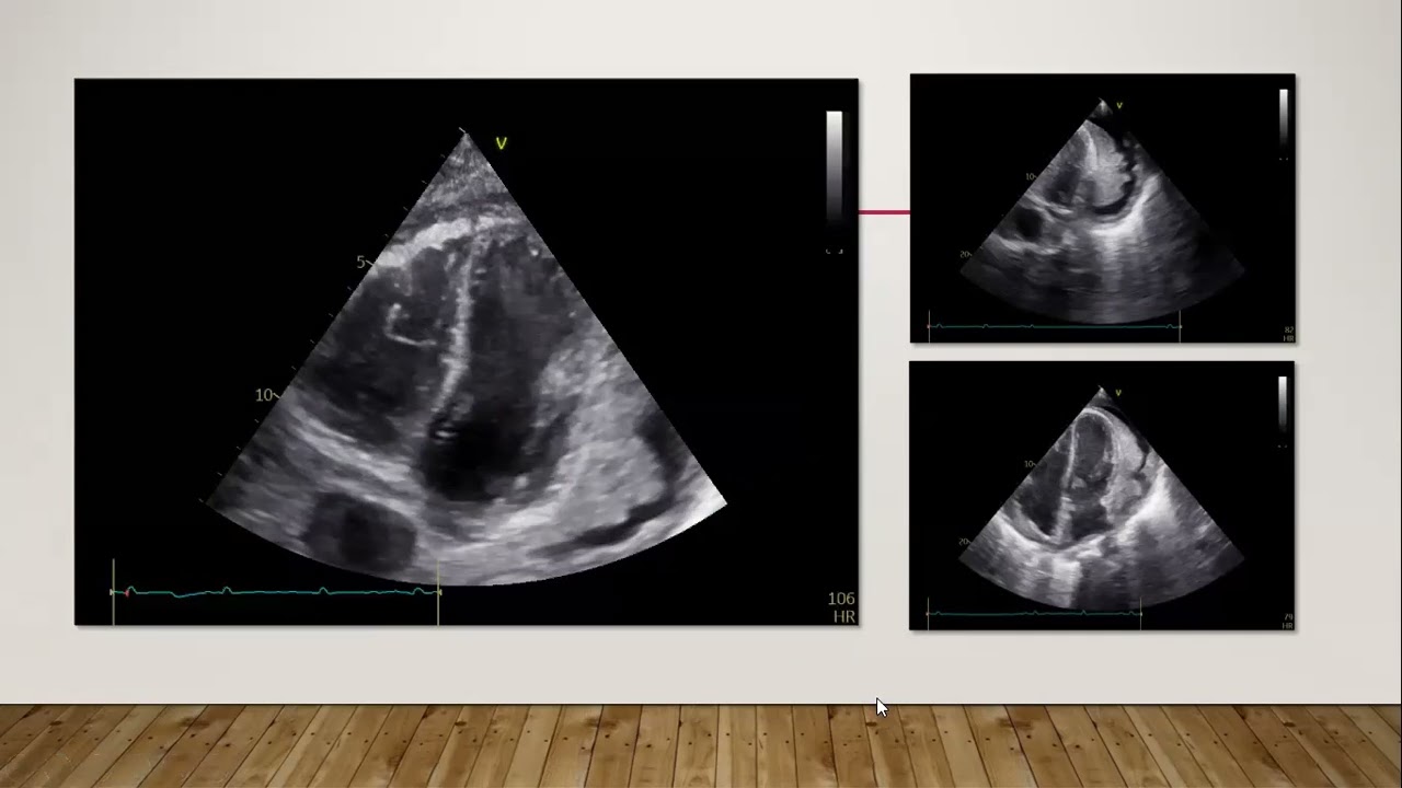 Echo conference -1/10/2025 - constrictive pericarditis