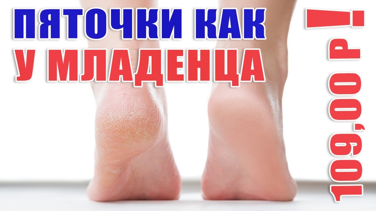 Скажи трещинам на пятках гудбай! Крутой крем для ног по очень бюджетной цене.