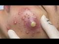 Feel The Extraction Through The Screen | Pimple Popping #800207