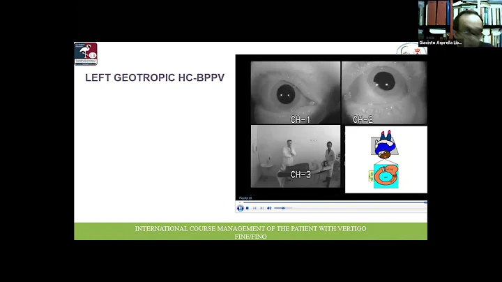 Benign Paroxysmal Positional Vertigo | Giacinto As...