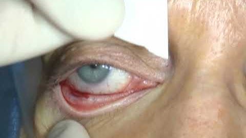 Conjunctival biopsy