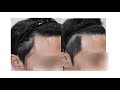 369번 관자놀이 구렛나루 비절개 1400모발이식/こめかみ・もみあげ・非切開1400毛