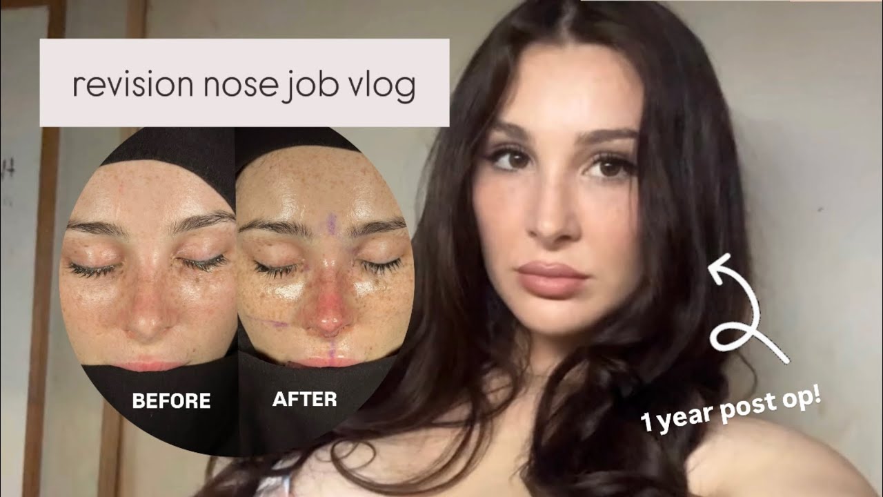 Исправляю свою НЕУДАЧНУЮ ринопластику! (видеоблог с исправлениями) + обновление за 1 год
