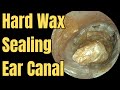 Hard Wax Sealing Ear Canal
