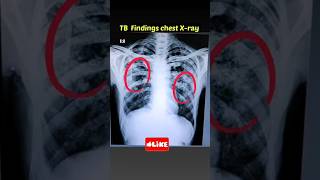 How to identify TB on Chest Xray?Normal Chest Xray Vs Tb Chest Xray