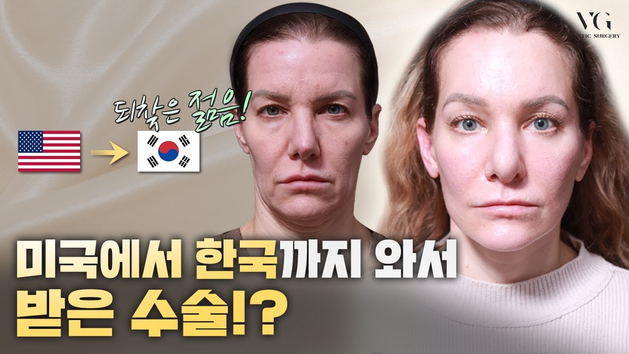 [Бэригүд гоо сайхны мэс заслын эмнэлэг] Солонгост гоо сайхны мэс засал хийлгэсний дараа огт өөр амьдралаар амьдарч эхэлсэн эмэгтэй.