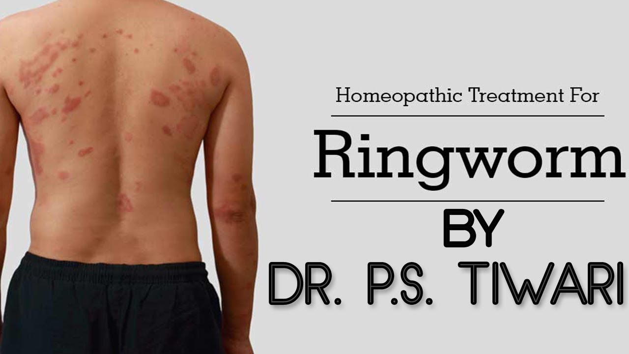 How to Treat Ringworm in Homeopathy by Dr. P.S. Tiwari - YouTube