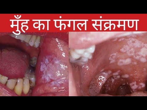 मुँह में सफेद दागों को कैसे सही करे ||मुँह का फंगल संक्रमण||Mouth Fungal Infection||सफेद दाग||