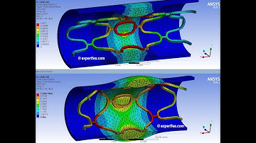 Structural simulation of a steel stent expansion - ANSYS WB Static Structural