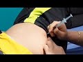 Intramuscular injection to girl in buttock #injection