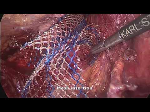 LVMR iMesh Fixation - P Giordano