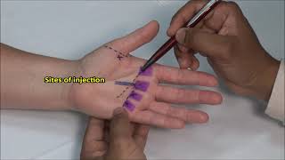 Flexor Tendonitis (Hand) Injection