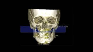 Romexis Software for 3D CEPH ANALYSIS