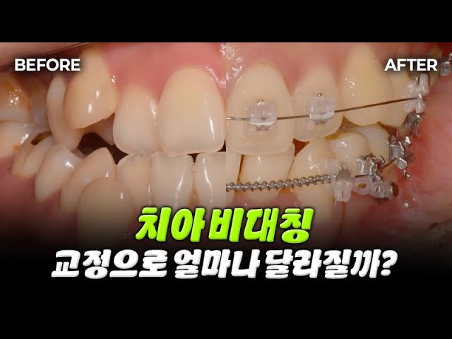 안면비대칭 수술없이 교정으로 가능할까?! (치아교정 얼굴비대칭교정)