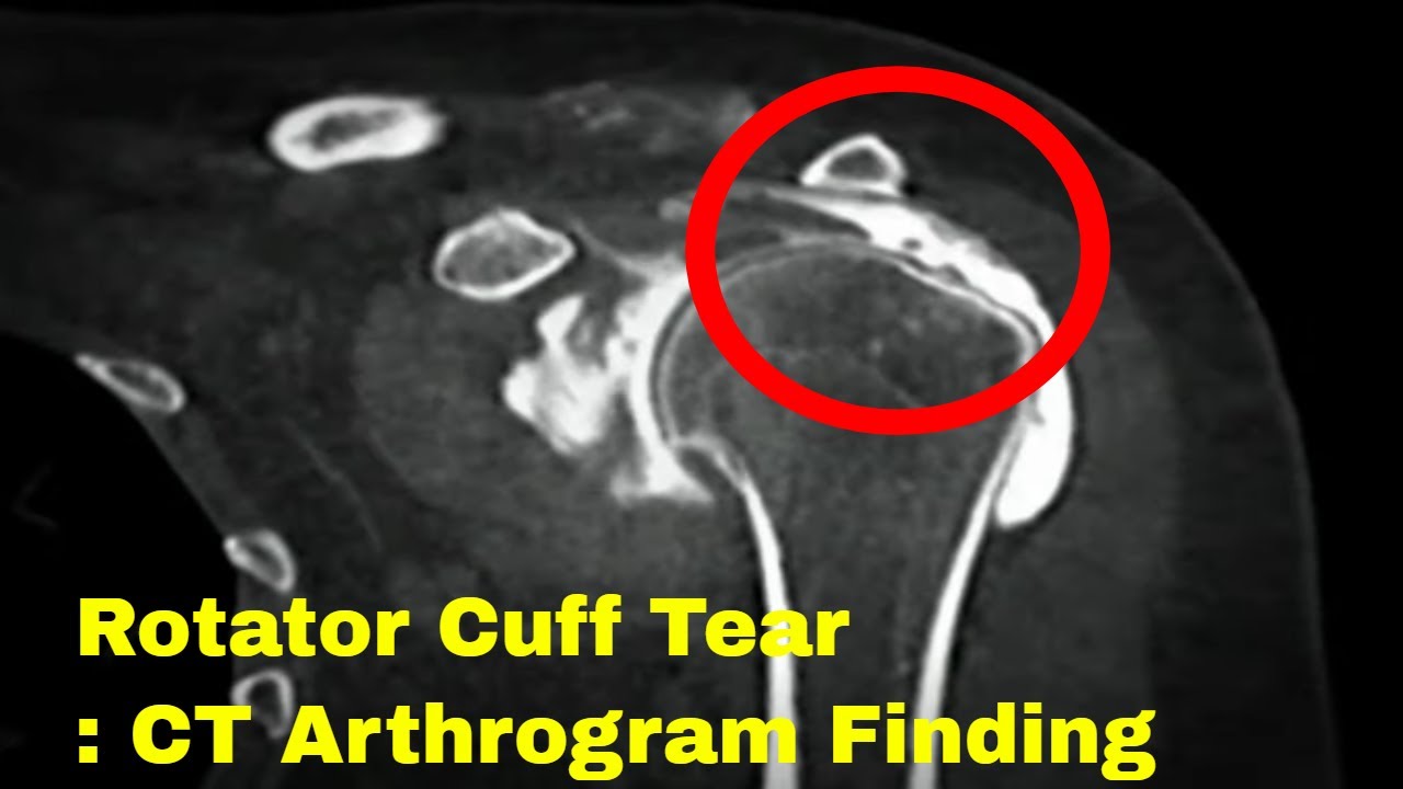 How Do You Treat A Full Thickness Rotator Cuff Tear
