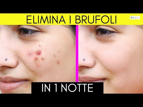 Video: 4 modi per trattare l'acne con l'aceto di mele