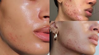 how i cleared my adult hormonal acne breakouts (for good)