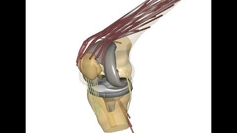 Kinematic modeling to restore the premorbid knee functionality through robotic-assisted TKA​