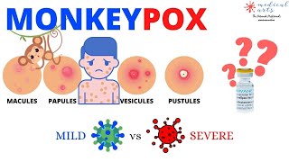 Monkeypox: all you need to know about Symptoms, transmission, Diagnosis, Treatment.