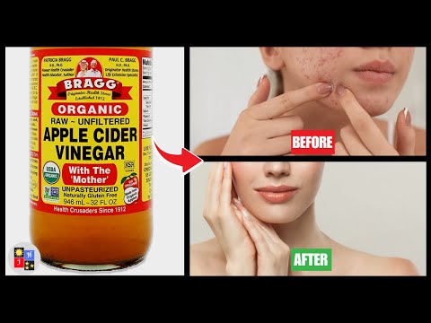 how-to-get-rid-of-acne-using-apple-cider-vinegar-|the-best-skincare-secret