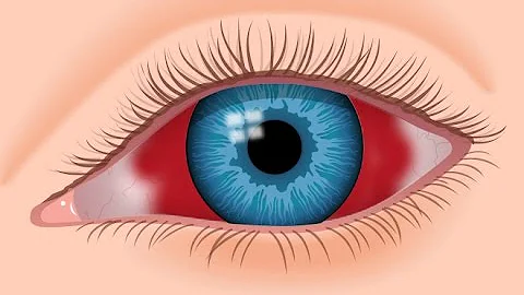 What is an Eye Hemorrhage