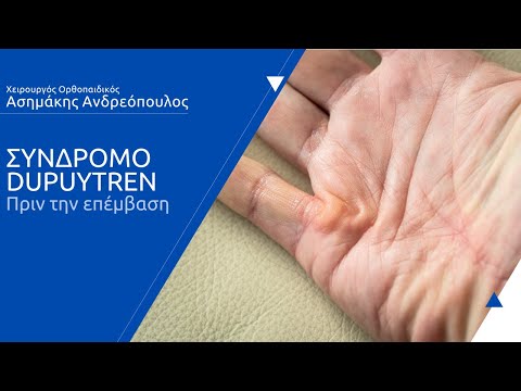 Σύνδρομο Dupuytren -