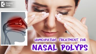 NASAL POLYPS | Best Homeopathic Treatment - Dr. V. Bhagyalakshmi | Doctors' Circle