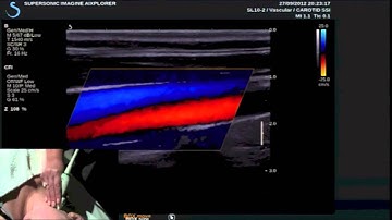 SVU 2013 - UltraFast™ Doppler (English)