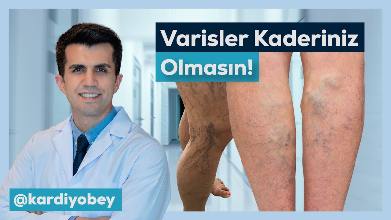 КАК ЛЕЧАТ ВАРИКОЗНОЕ РАСШИРЕНИЕ ВЕН?