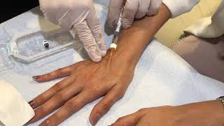 Hand Rejuvenation Using Restylane Lyft With Dr. Zadeh - Los Angeles