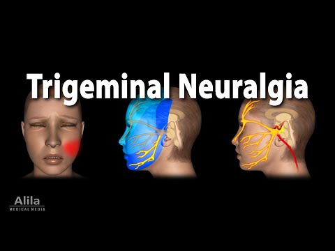 Videó: A trigeminus neuralgia duzzanatot okoz?